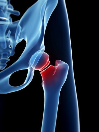 My Hip Fracture